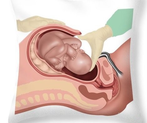 Trẻ tổn thương phổi, tử vong sau sinh do mổ lấy thai khi chưa có cơn chuyển dạ