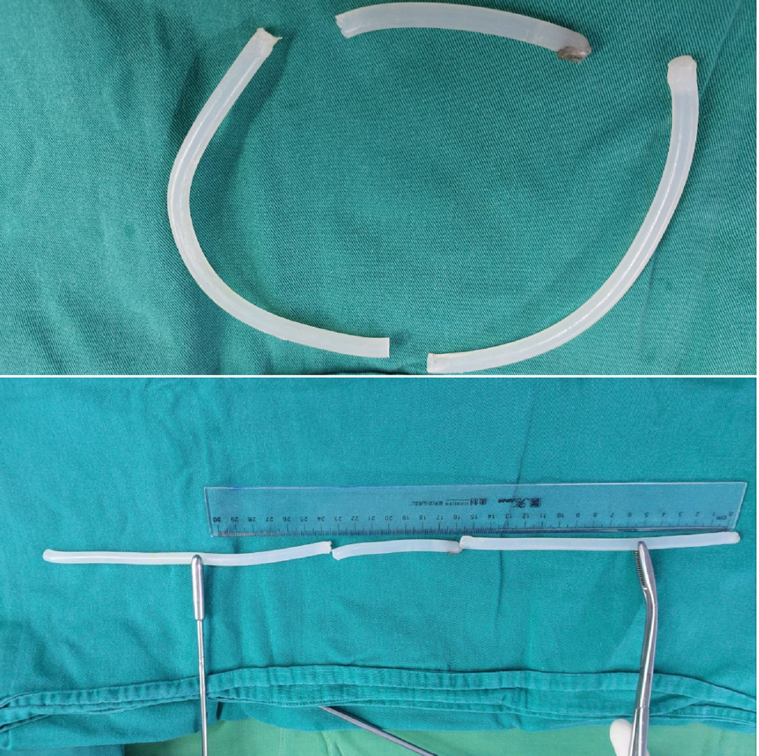 Gặp hoạ vì nhét keo nến dài 40cm vào niệu đạo để tự sướng