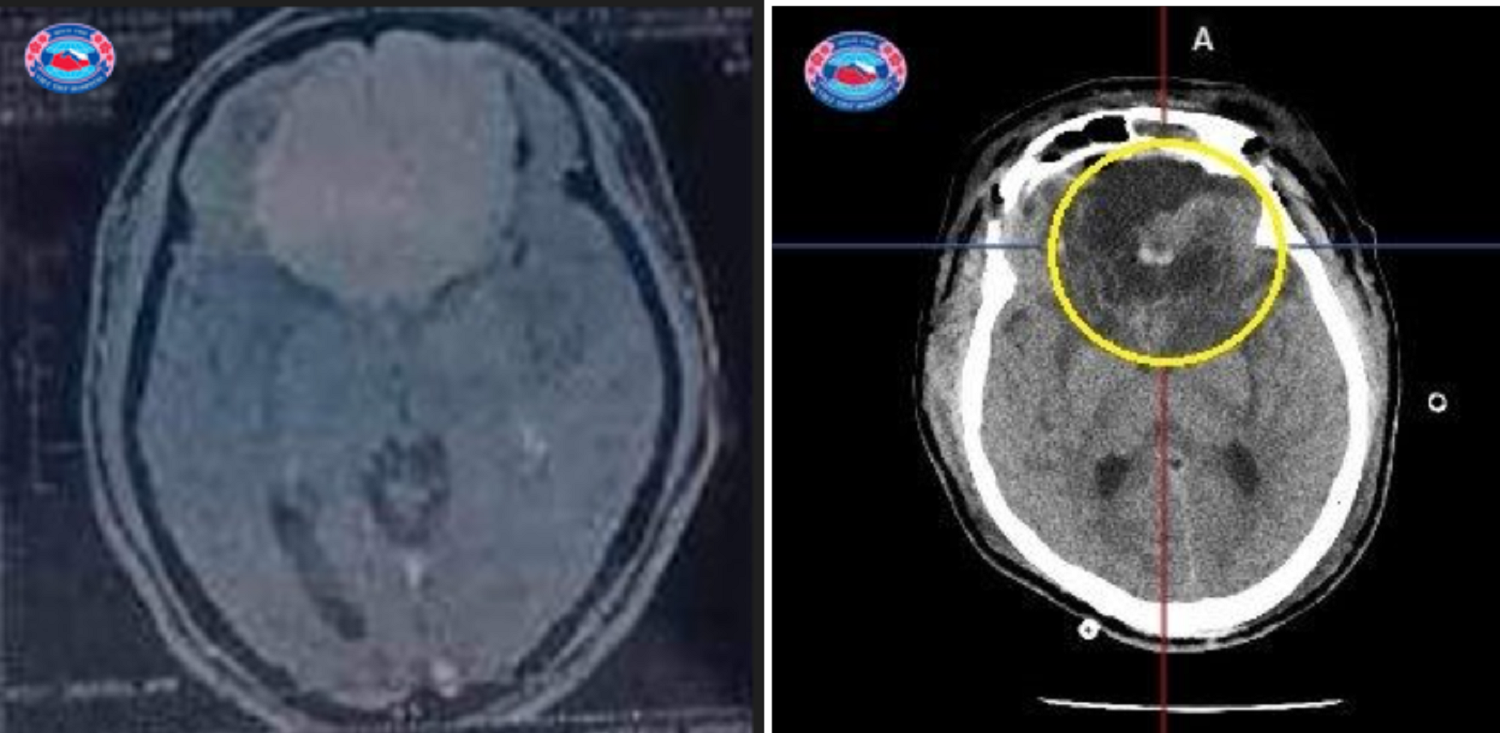 Đau đầu, chóng mặt vào viện phát hiện khối u màng não khổng lồ