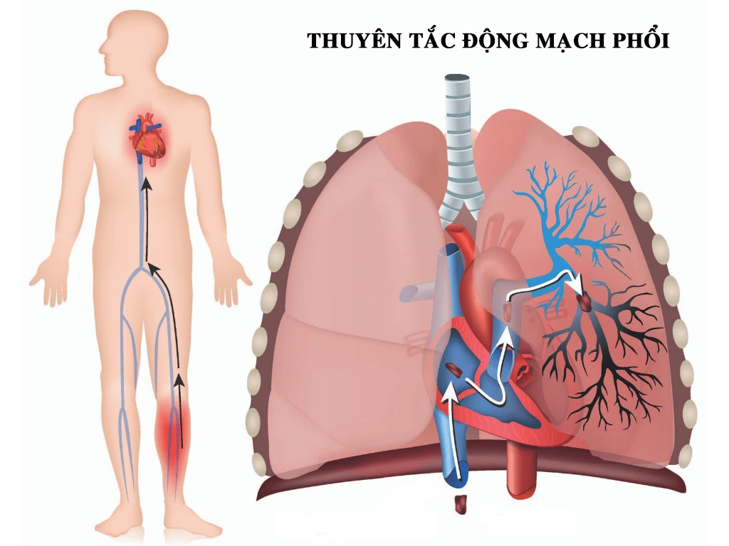 Thuyen-tac-dong-mach-phoi03