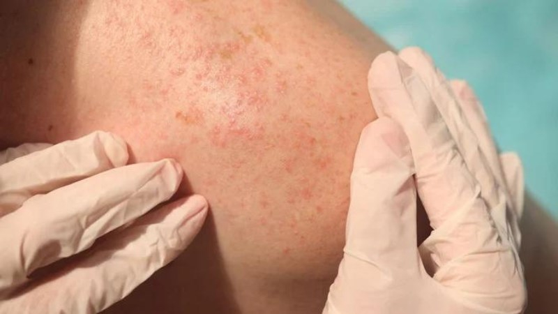 Cảnh báo bệnh về da thường gặp trong mùa hè và cách phòng tránh