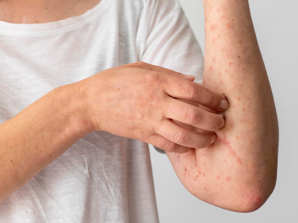 Cảnh báo bệnh về da thường gặp trong mùa hè và cách phòng tránh