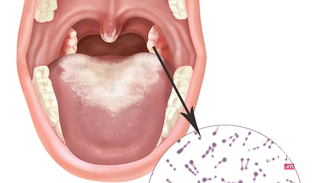 Bộ Y tế yêu cầu phát hiện sớm, xử lý triệt để nguy cơ lây lan bệnh bạch hầu