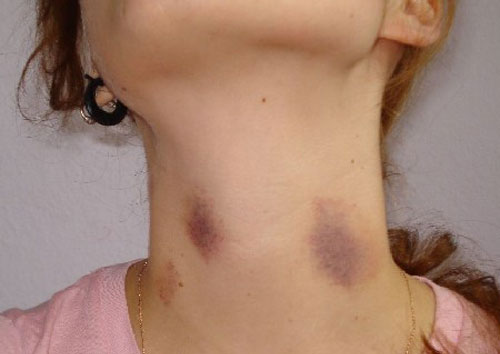 Vết cắn yêu hickey có nguy hiểm không, làm mờ bằng cách nào?