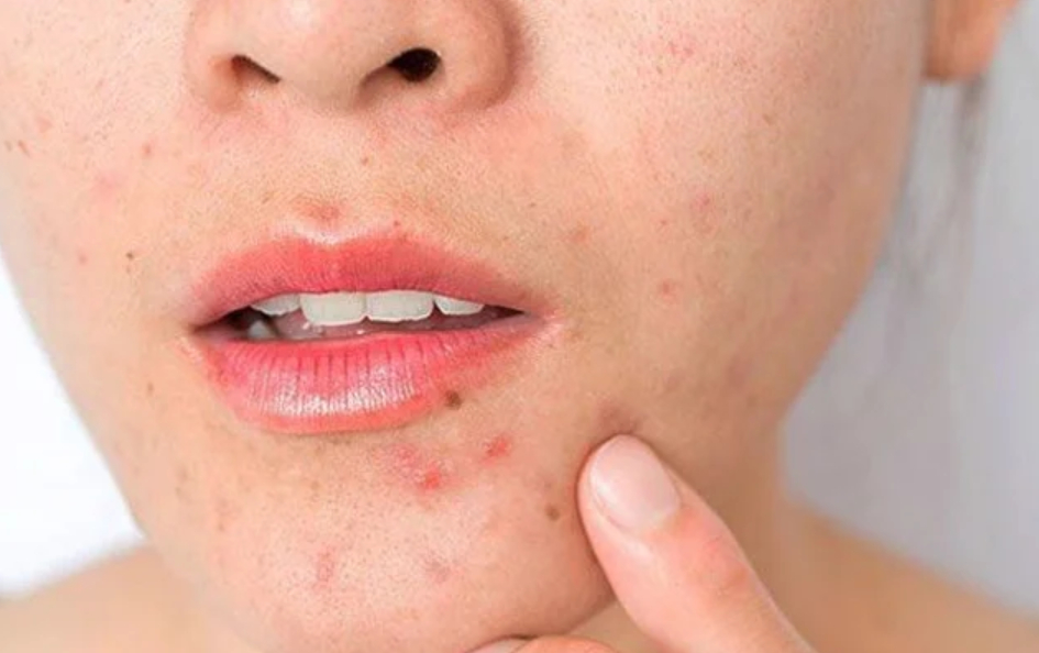 8 sai lầm khiến da dễ nổi mụn khi chuyển mùa