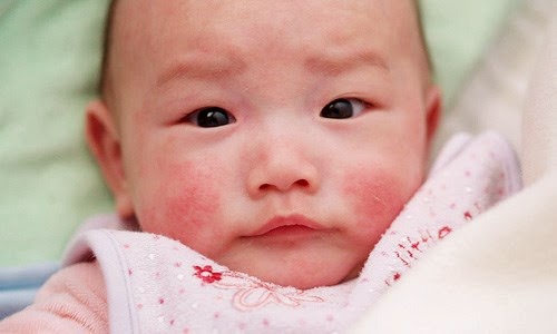 nhung-bien-chung-dang-so-cua-benh-soi-giadinhonline.vn 2