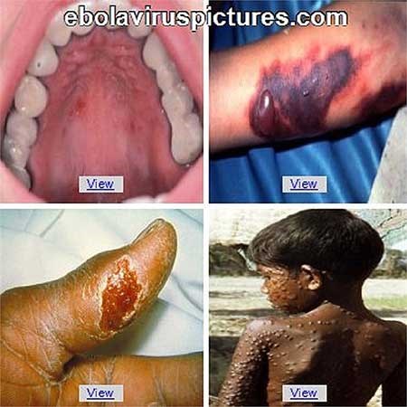 virus-ebola-tan-cong-co-the-con-nguoi-nhu-the-nao-giadinhonline.vn 4