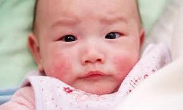 nhung-dieu-cha-me-can-lam-khi-tre-bi-viem-da-di-ung--giadinhonline.vn 1