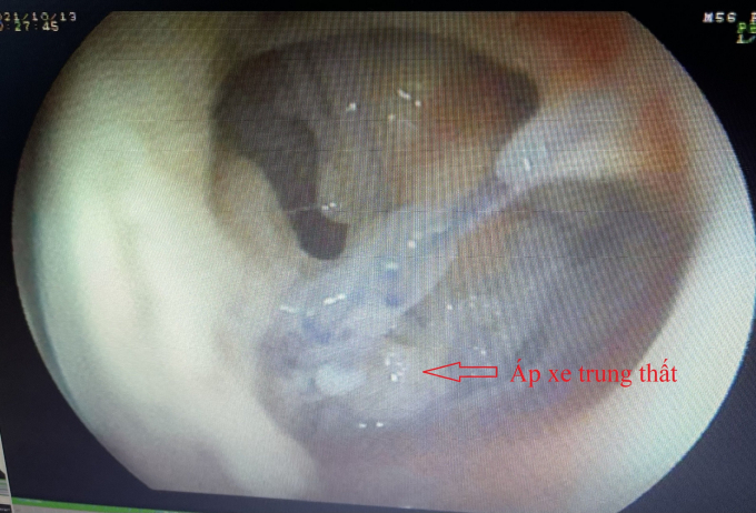 Hình ảnh áp xe trên nội soi tiêu hóa.