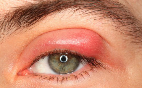 Có thể nói, viêm giác mạc là trường hợp xấu nhất có thể diễn ra do mắt bị kích ứng với keo dán mi kém chất lượng. Ngoài ra, với tay nghề kém cũng dễ dẫn đến trường hợp bít tắc tuyến bã nhờn ở chân mi. Ảnh: soha.