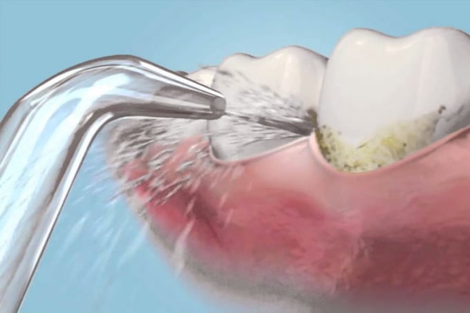 Chúng ta có thể tự điều chỉnh mức độ tia nước sao cho phù hợp với răng miệng của chúng ta. Tia nước khá dịu nhẹ nên an toàn với nướu răng, nhất là với những bạn đang trong quá trình niềng răng. Ảnh: Internet.