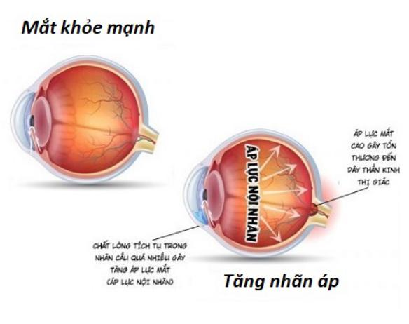 Tăng nhãn áp là nguyên nhân gây mù lòa.