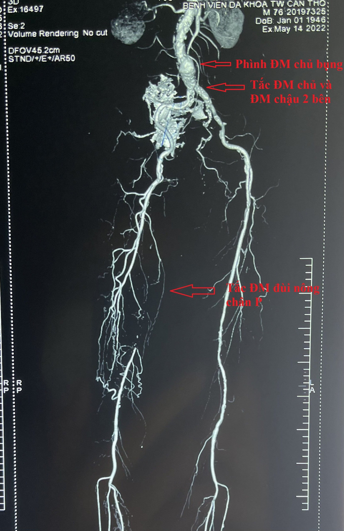 Hình ảnh chụp cắt lớp vi tính mạch máu có cản quang.