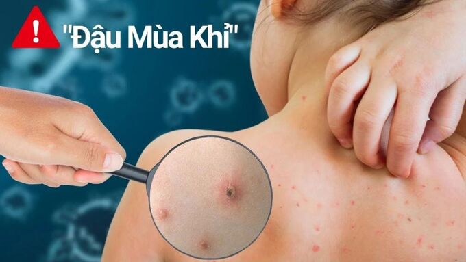 Có nhiều hình thức và nguồn lây truyền bệnh đậu mùa khỉ (Ảnh minh họa).