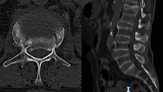 CTs cột sống: xẹp lún mất vững đốt sống L1 kèm thoái hóa cột sống.