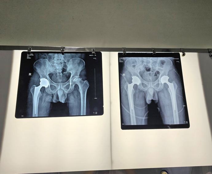 Phim X quang trước phẫu thuật (trái) và sau (phải) phẫu thuật.
