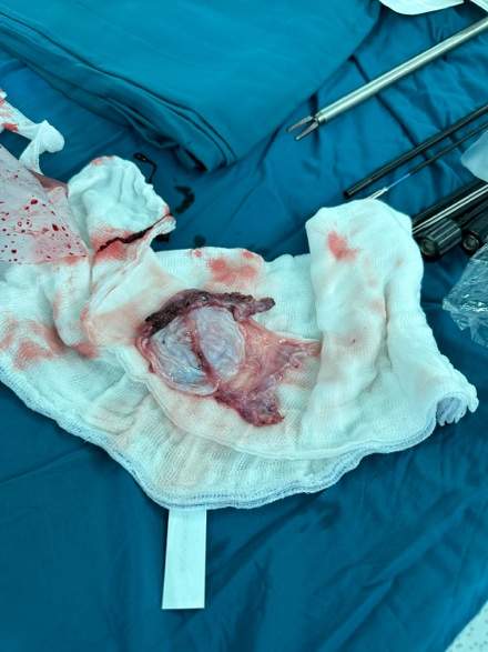 Mẫu bệnh phẩm của nang nước cạnh vòi trứng sau khi hút dịch trong nang mang ra ngoài trong phòng phẫu thuật nội soi - (Ảnh Khoa Sản Phụ khoa).