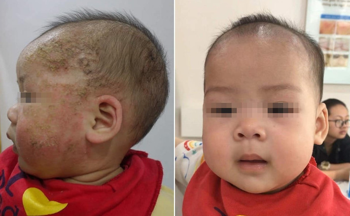 Bé trai 8 tháng tuổi biến chứng nặng do điều trị viêm da cơ địa sai cách (Ảnh: BSCC)