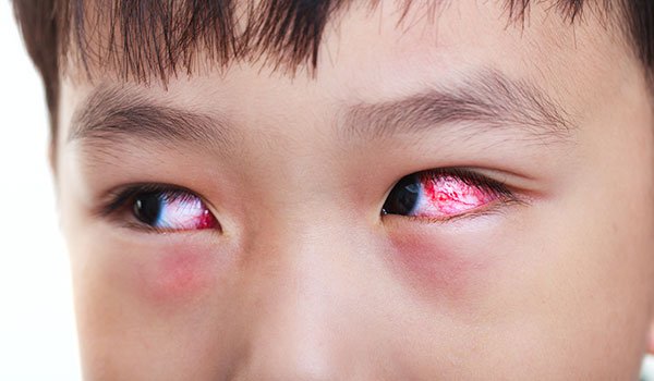 Đau mắt đỏ có thể xuất hiện ở bất kì ai, đặc biệt là trẻ em. Ảnh minh họa.