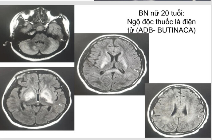 Hình ảnh não bệnh nhân bị tổn thương nặng do sử dụng thuốc lá điện tử.