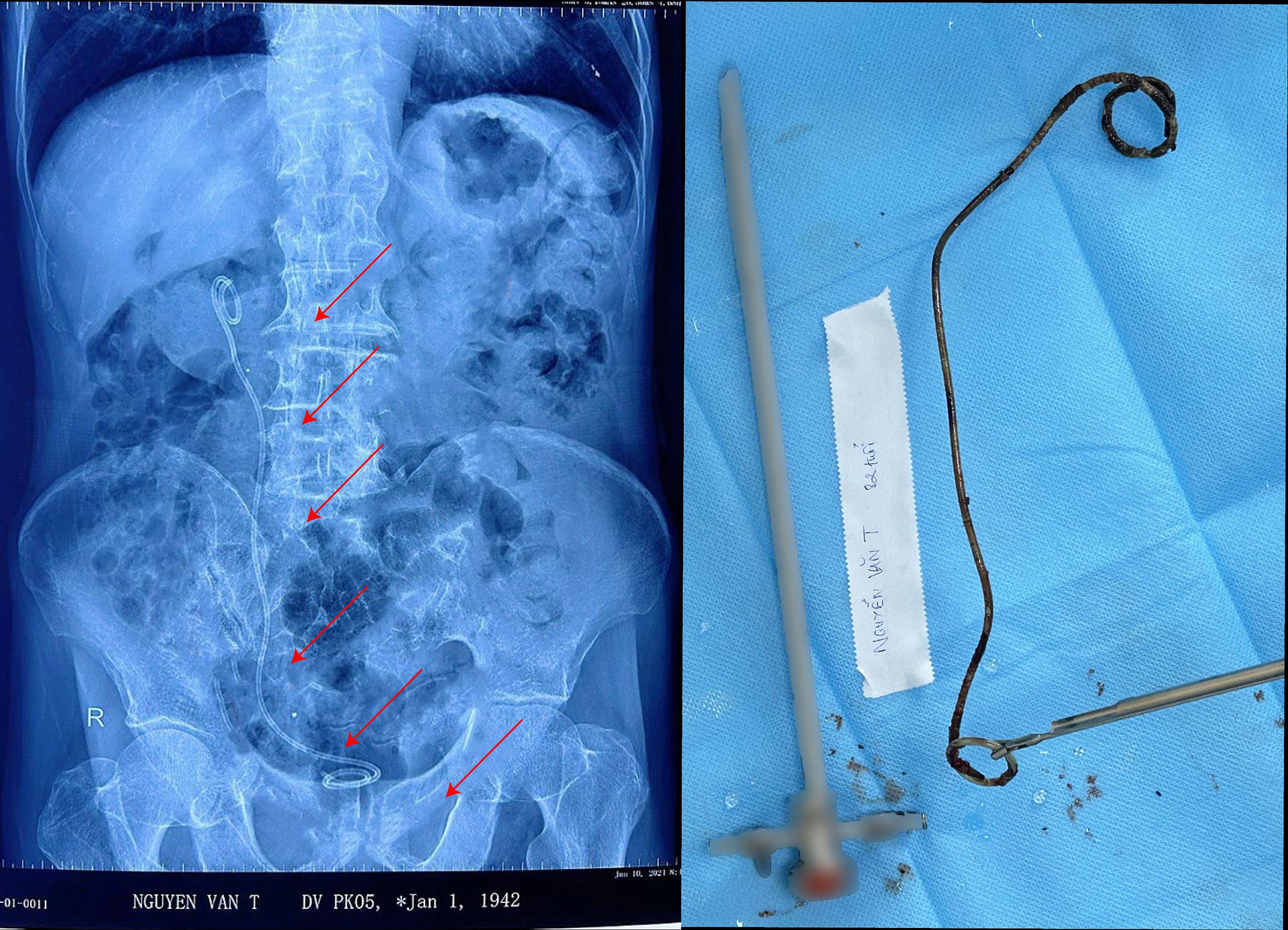 Dị vật được lấy ra khỏi người bệnh nhân. Ảnh: BVCC.