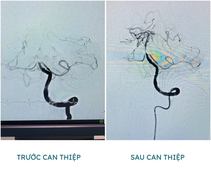 Trước và sau can thiệp, mạch máu được tái thông