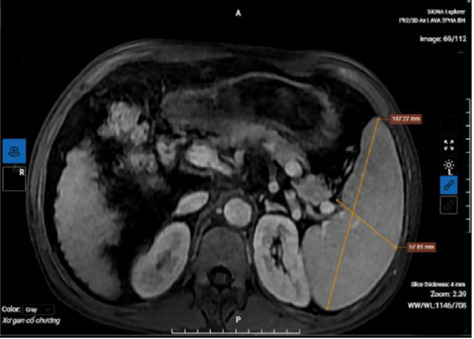 Kết quả chụp MRI của bệnh nhân cho thấy hình ảnh xơ gan lách to, dịch bao quanh gan.