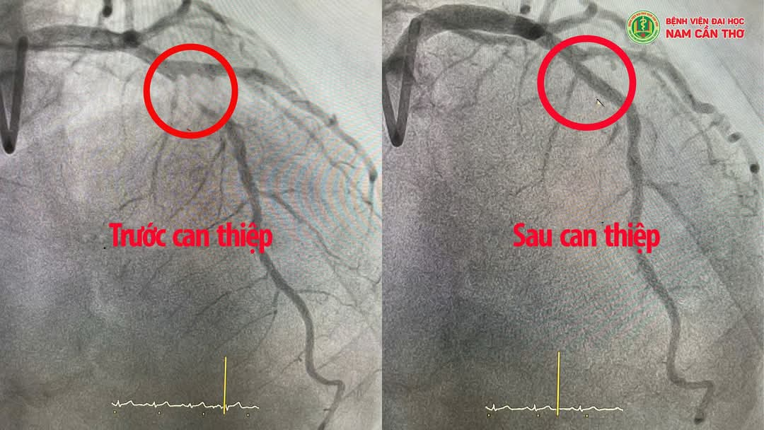 Hình ảnh mạch máu trước và sau khi can thiệp.
