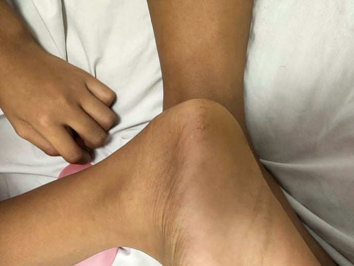 Vết thương sau khi đã được xử lý kịp thời tại bệnh viện