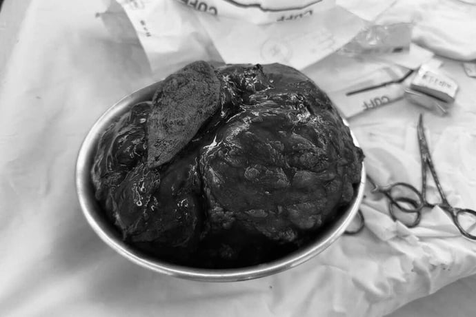 Khối u sau khi được bóc tách – nặng gần 2kg, chứa mô hoại tử và tổ chức dạng sợi đặc trưng của u diệp thể.