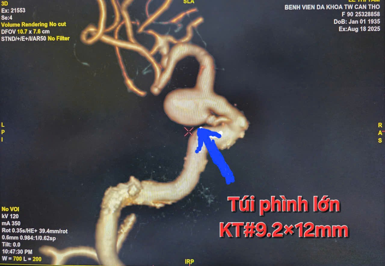 Hình ảnh túi phình kích thước lớn trên DSA.