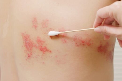 Gallery - Người ta không bị zona thần kinh một cách ngẫu nhiên! Nghiên cứu đã chỉ ra rằng hầu hết những người bị zona đều có bốn đặc điểm chung - image 3