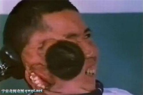 Hy hữu: Những trường hợp “người hai mặt” trên thế giới - 3