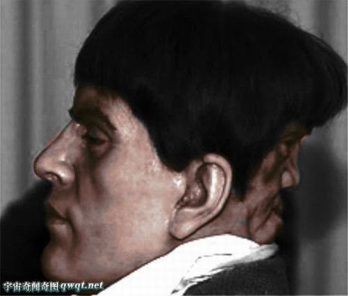 Hy hữu: Những trường hợp “người hai mặt” trên thế giới - 2