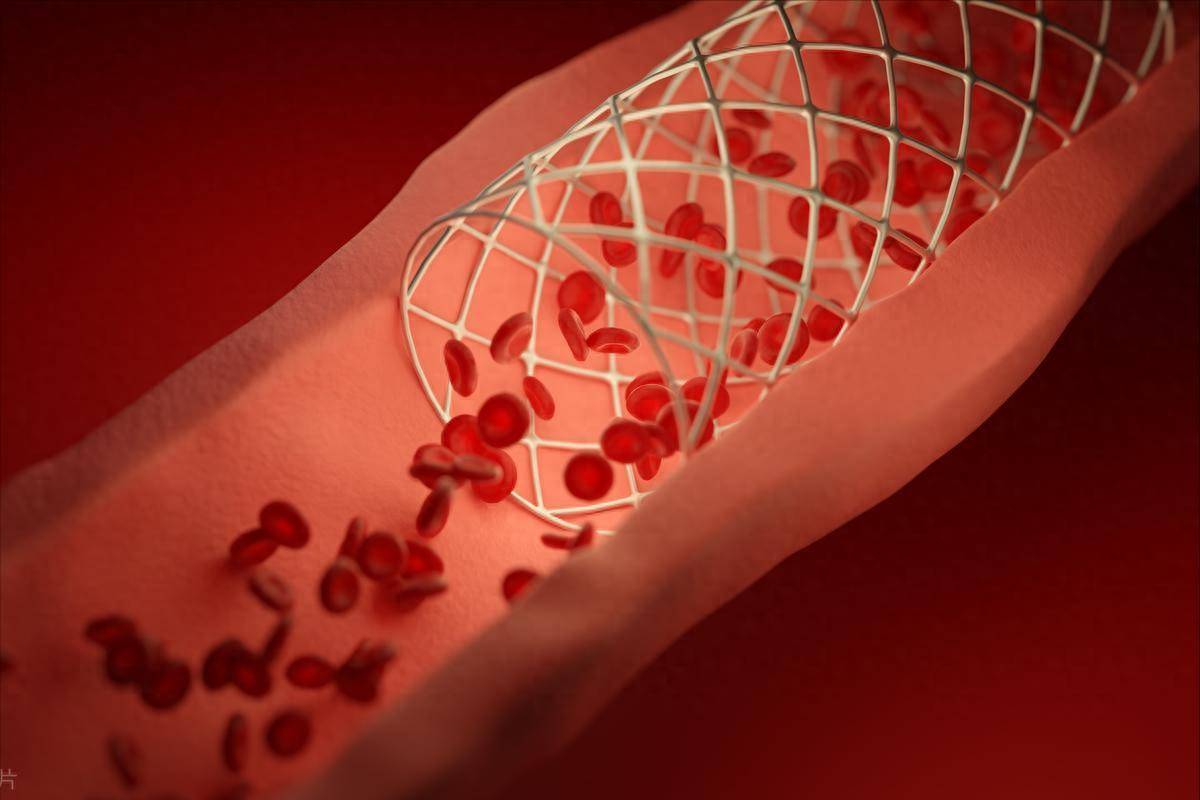 Gallery - Một người có thể sống thêm bao nhiêu năm nữa sau khi được cấy ghép stent tim? Bác sĩ không còn giấu giếm sự thật nữa và đã nói ra sự thật - image 2