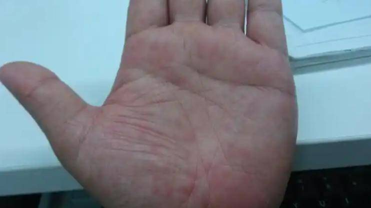 Gallery - Bốn loại ngứa có thể là tín hiệu báo động một bệnh nghiêm trọng sắp xảy ra? Đừng chần chừ đi khám nữa! - image 6