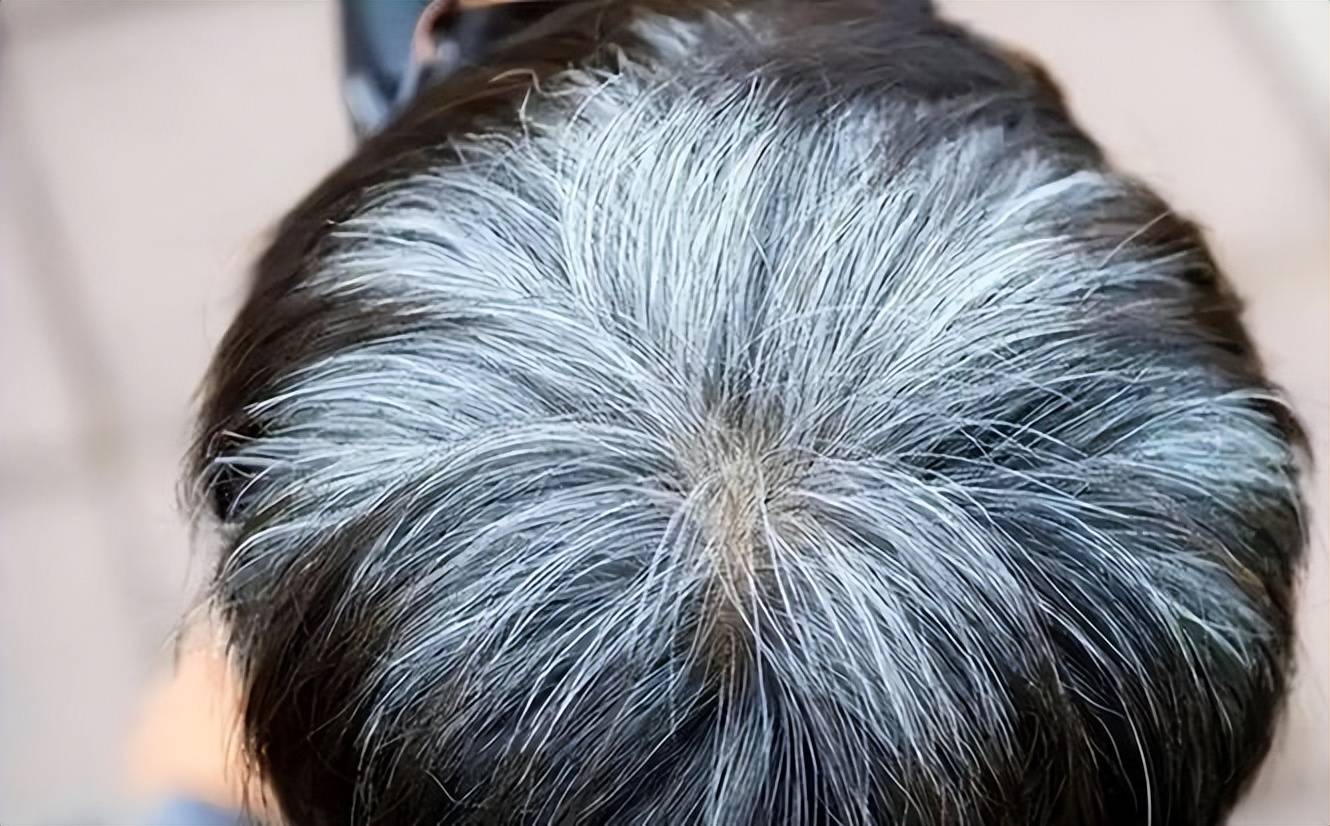 Gallery - Xác suất mắc ung thư trong đời là bao nhiêu? Bác sĩ: Những người bị bạc tóc sớm có thể có nguy cơ mắc ung thư thấp hơn? - image 4