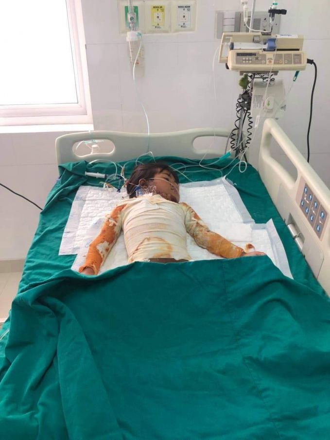 Bé Y Hạng bị bỏng nặng đã được đưa vào bệnh viện Nhi Đồng 2 điều trị.