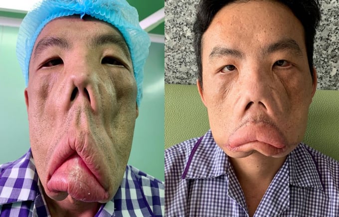 Khuôn mặt của Lê Văn Mến trước và sau khi tiến hành phẫu thuật điều trị căn bệnh hiếm gặp MRS.