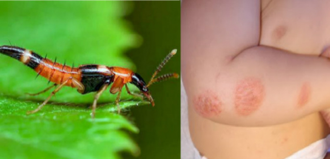 Viêm da do kiến ba khoang hay xuất hiện ở các vùng da hở như cổ, mặt, lưng, tay, chân… Ảnh minh họa.