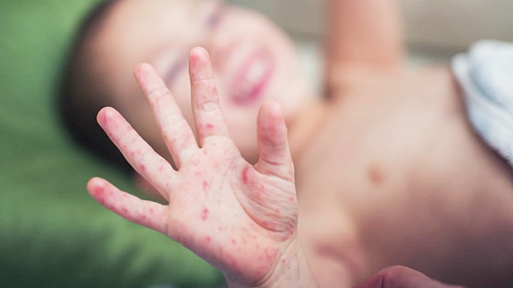 Bệnh chân tay miệng ở trẻ đang gia tăng ở Đắk Lắk