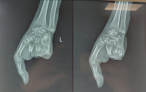 Hình chụp X-quang ngón tay bị nát.