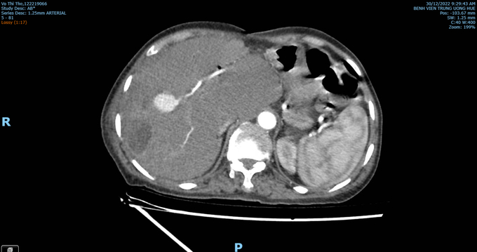 Hình ảnh áp-xe gan và khối giả phình động mạch ở gan phải của bệnh nhân Th. Ảnh: BVH.