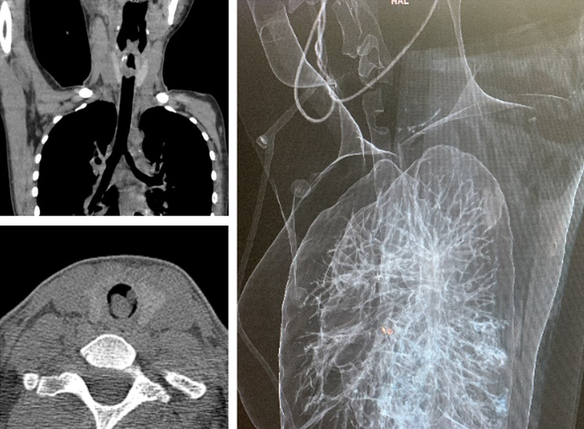 Hình ảnh khối u lớn khí quản trên cắt lớp vi tính dựng hình 3D.