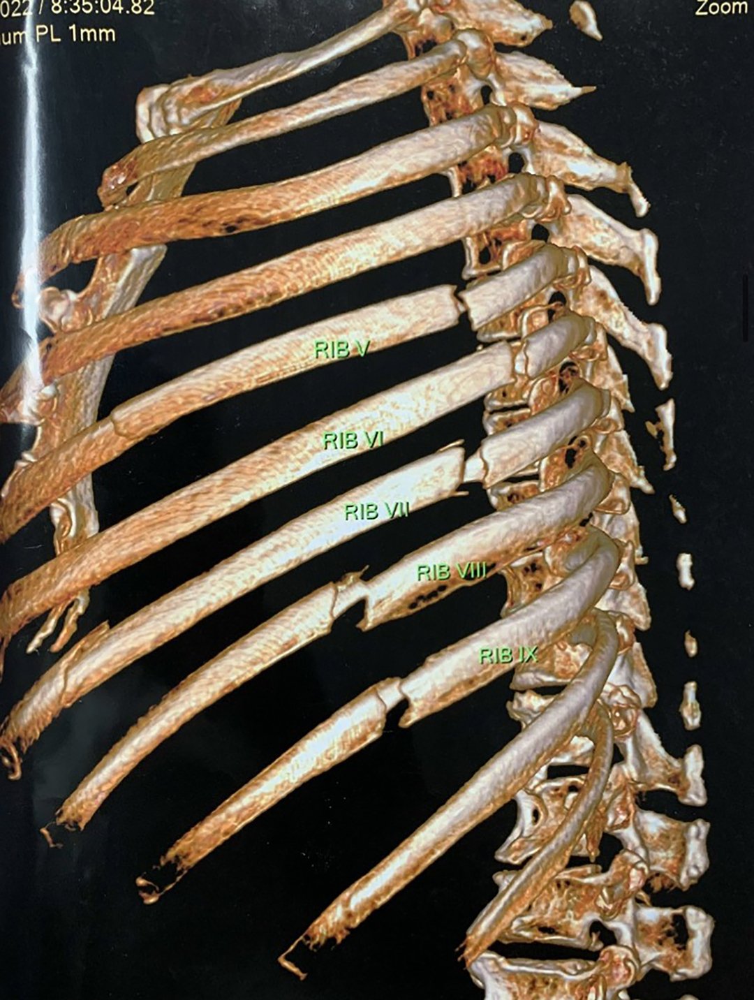 Hình ảnh CT-scan dựng hình trước phẫu thuật cố định xương sườn cho ông T. Ảnh: Bệnh viện cung cấp.