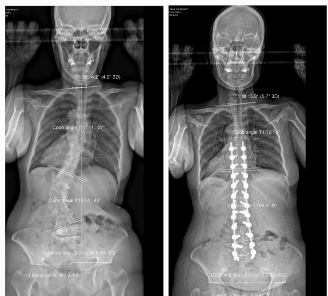 Hình ảnh cột sống của bệnh nhân trước và sau khi phẫu thuật. Ảnh: BVCC.