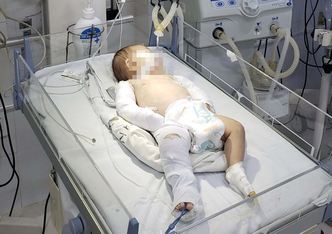 Bé gái hơn 2 tháng tuổi phải nhập viện cấp cứu trong tình trạng đa chấn thương, hôn mê. 