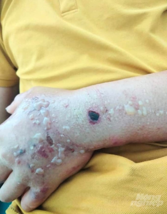 Cánh tay của bệnh nhân Lầu Mí Sò, thôn Quán Xí, xã Lũng Pù, huyện Mèo Vạc bị mắc bệnh nhiệt thán. Ảnh: Đào Thanh.