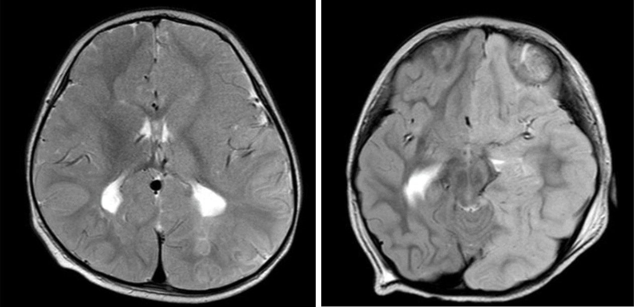 Hình MRI chuỗi xung T2W của bệnh nhi L.T.N và bệnh nhi N.H.X.