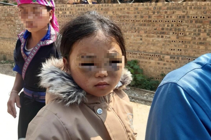 Hình ảnh học sinh Lù Thị L. bị cô giáo đánh tím mắt. Ảnh: Gia đình cung cấp.